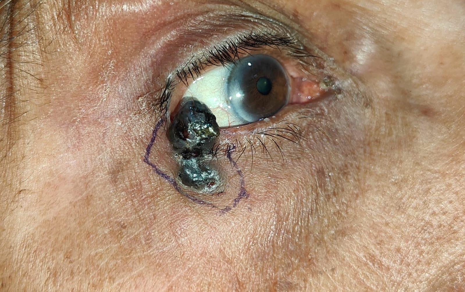 Right lower lid malignant lesion, basal cell carcinoma